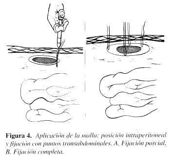 Aplicación de la Malla: Posición Intraperitonea Aplicación de la Malla: Posición Intraperitonea
