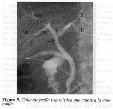 Colangiografía Transcística que muestra la Anatomía Colangiografía Transcística que muestra la Anatomía