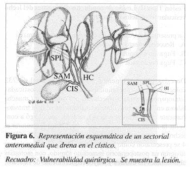 Sectorial Anteromedial que Drena en el Cístico Sectorial Anteromedial que Drena en el Cístico