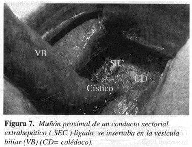 Muñón Proximal de un conducto Sectorial Eextrahepático Muñón Proximal de un conducto Sectorial Eextrahepático