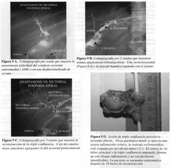 Colangiografia por Sonda que muestra la Anastomosis Colangiografia por Sonda que muestra la Anastomosis