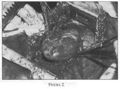 Trauma Cardíaco, incisión es inadecuada