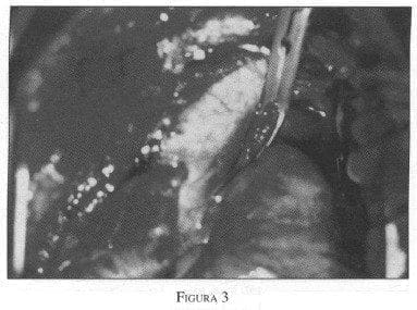 Exposición del Corazón, la Aorta y la Pulmonar