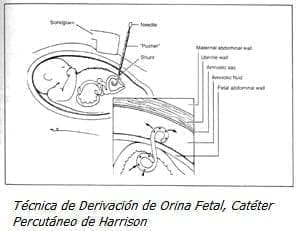 Orina Fetal, Catéter Percutáneo de Harrison Orina Fetal, Catéter Percutáneo de Harrison