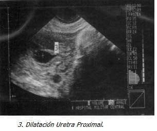Dilatación Uretra Proximal Dilatación Uretra Proximal