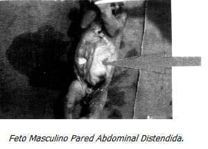 Feto Masculino Pared Abdominal Distendida Feto Masculino Pared Abdominal Distendida