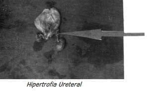 Hipertrofia Ureteral Hipertrofia Ureteral
