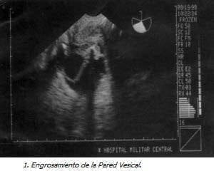 Engrosamiento de la Pared Vesical Engrosamiento de la Pared Vesical
