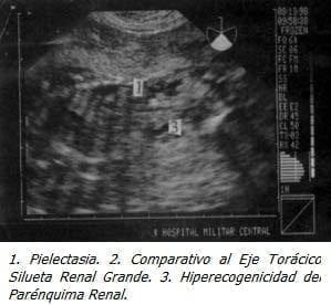 Pielectasia, Eje Torácico, Parénquima Renal Pielectasia, Eje Torácico, Parénquima Renal