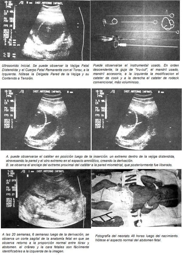 Inserción a partir de una aguja de biopsia "true-cut"