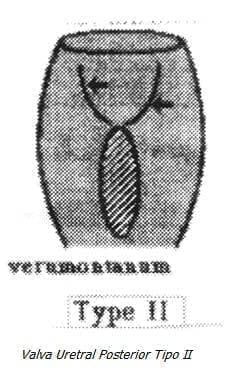 Valva Uretral Posterior Tipo II Valva Uretral Posterior Tipo II