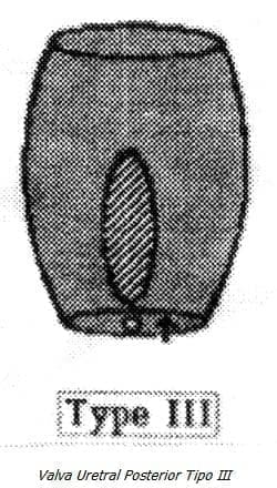 Valva Uretral Posterior Tipo III Valva Uretral Posterior Tipo III