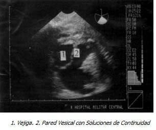 Vejiga, Pared Vesical con Soluciones de Continuidad. Vejiga, Pared Vesical con Soluciones de Continuidad.