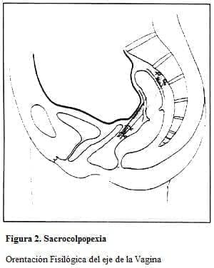 Sacrocolpopexia