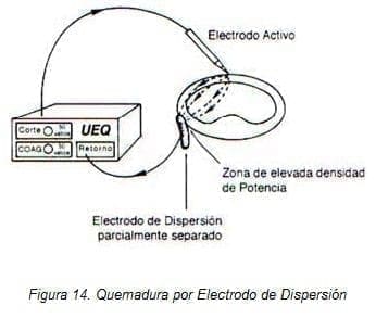 Quemadura por Electrodo de Dispersión Quemadura por Electrodo de Dispersión