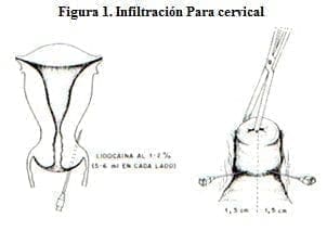 Infiltración Paracervical Infiltración Paracervical