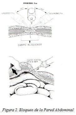 Bloqueo de la Pared Abdominal Bloqueo de la Pared Abdominal