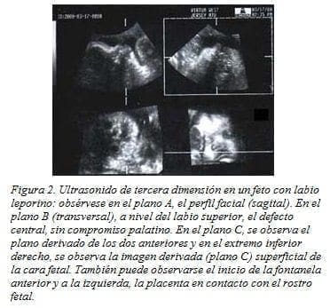 Ultrasonido de Tercera Dimensión en un Feto con Labio Leporino Ultrasonido de Tercera Dimensión en un Feto con Labio Leporino