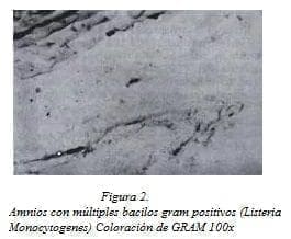 Amnios con Múltiples Bacilos Gram Positivos