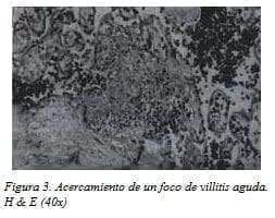 Acercamiento de un Foco de Villitis Aguda