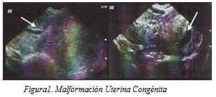 Malformación Uterina Congénita Malformación Uterina Congénita
