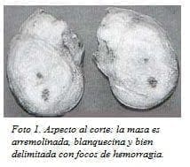 Masa es Arremolinada, Blanquecina y bien delimitada  Masa es Arremolinada, Blanquecina y bien delimitada