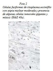 Células Fusiformes de Citoplasma Eosinófilo