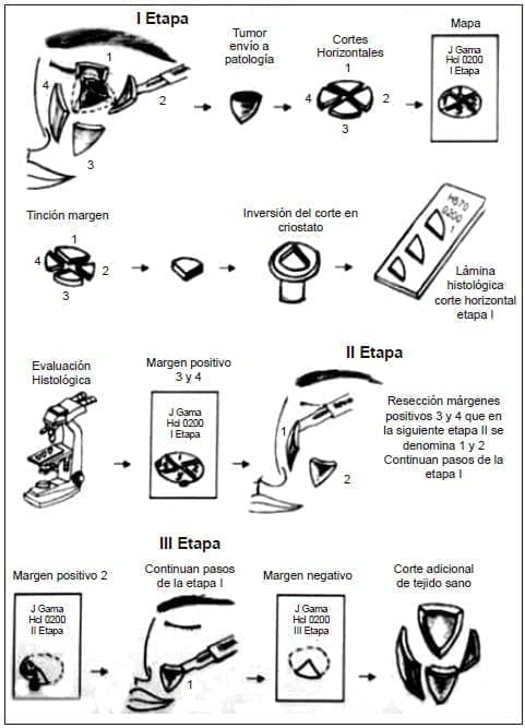 Cirugía micrográfica de Mohs
