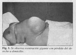 Eventración Gigante con Pérdida del Derecho a Domicilio