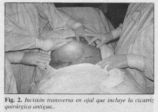 Cicatriz Quirúrgica Antigua