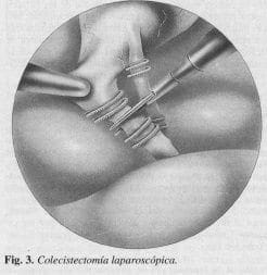 Colecistectomía Laparoscópica Colecistectomía Laparoscópica