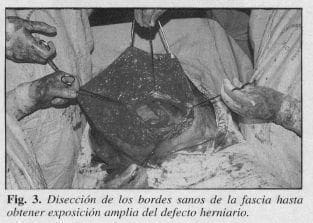 Exposición Amplia del Defecto Herniario
