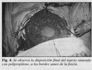 Disposición final del Injerto Suturado con Polipropileno