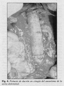Prótesis de Dacrón en Cirugía del Aneurisma Prótesis de Dacrón en Cirugía del Aneurisma