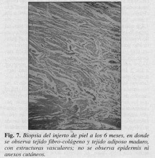 Biopsia del Injerto de Piel a los 6 meses