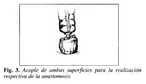 Realización Respectiva de la Anastomosis Realización Respectiva de la Anastomosis