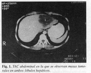 Masas Tumorales en ambos Lóbulos Hepáticos Masas Tumorales en ambos Lóbulos Hepáticos
