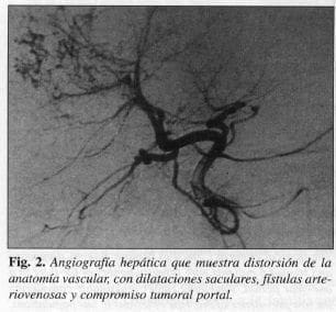 Angiografía Hepática que muestra distorsión de la Anatomía Vascular Angiografía Hepática que muestra distorsión de la Anatomía Vascular