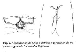 Canales Linfáticos Canales Linfáticos