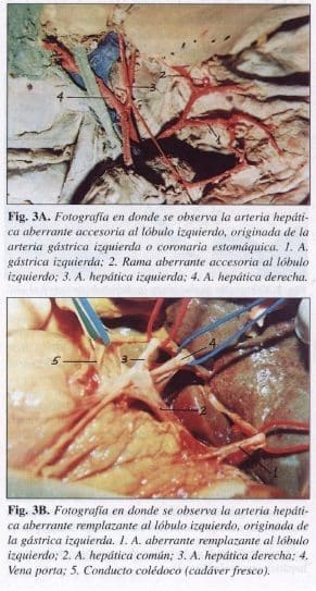 Arteria Hepática Aberrante accesoria al Lóbulo izquierdo