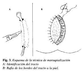 Técnica de Marsupialización Técnica de Marsupialización