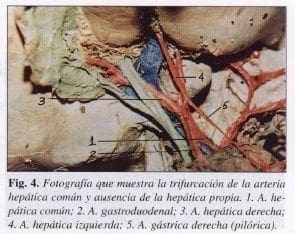 Trifurcación de la Arteria Hepática común y ausencia de la Hepática Propia