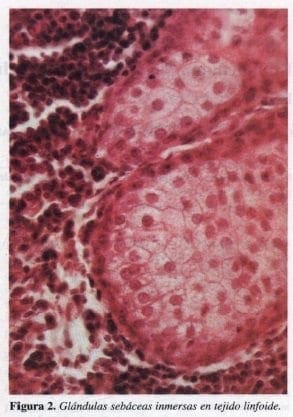 Glándulas Sebáceas Inmersas en Tejido Linfoide Glándulas Sebáceas Inmersas en Tejido Linfoide
