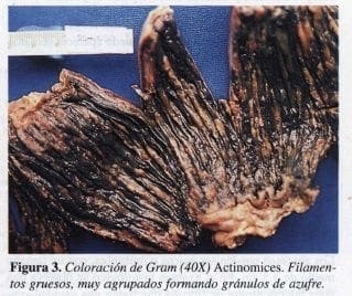 Coloración de Gram, Actinomices