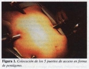 Colocación de los 5 puertos de acceso en forma de Pentágono