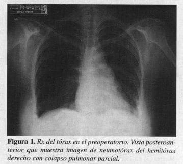 Rx del Tórax en el Preoperatorio