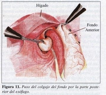 Paso del Colgajo del fondo por la parte posterior del Esófago