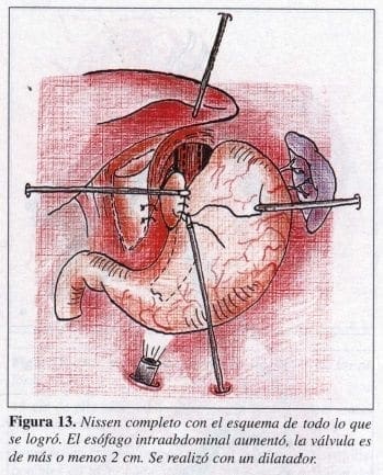 Nissen Completo con el Esquema