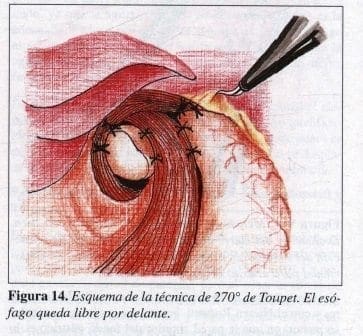 Esquema de la técnica de 2700 de Toupet