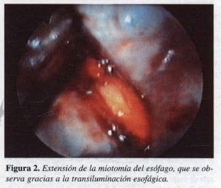 Extensión de la Miotomía del Esófago